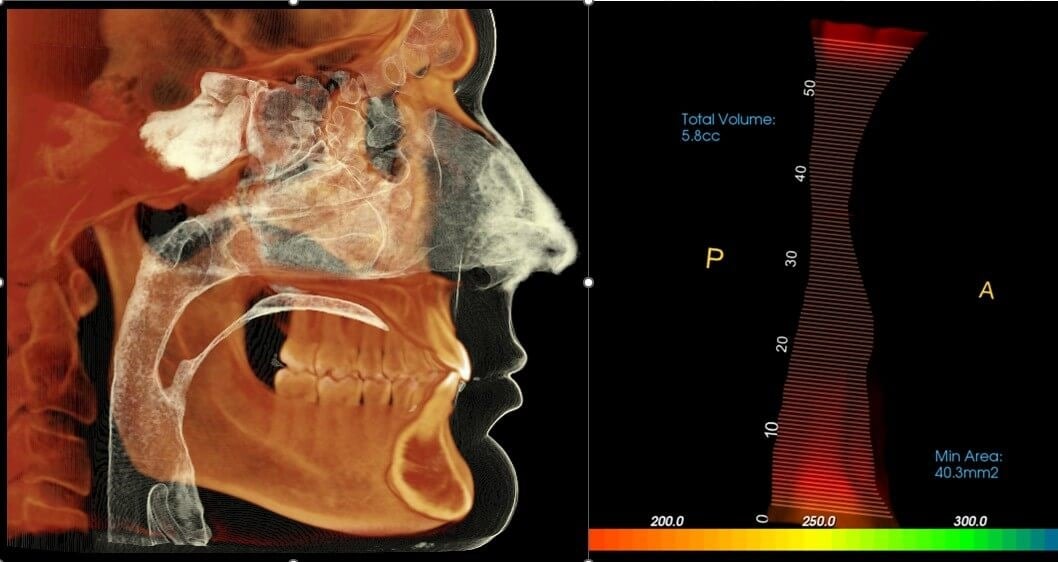 3D CBCT Airway Imaging at Space City Orthodontics
